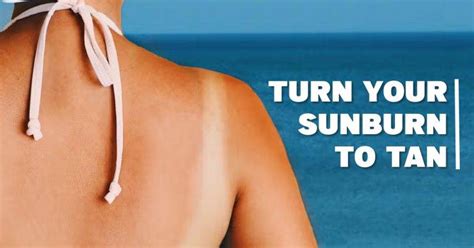 how to turn sunburn to tan